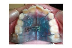 Appareil dentaire amovible Strasbourg Appareil dentaire amovible Strasbourg