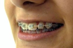 appareil-dentaire-strasbourg appareil-dentaire-strasbourg