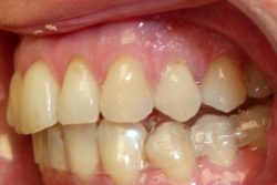 Gouttière orthodontie schiltigheim Gouttière orthodontie schiltigheim