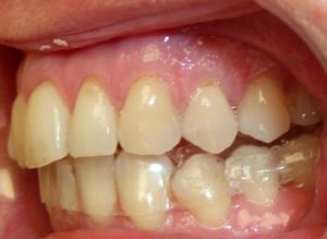 Gouttière orthodontie schiltigheim