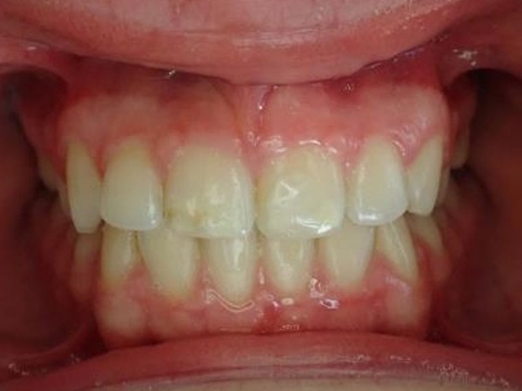 orthodontie-patient-02-apres