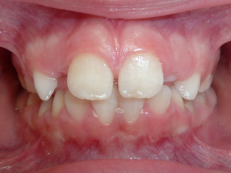 orthodontie-patient-03-apres
