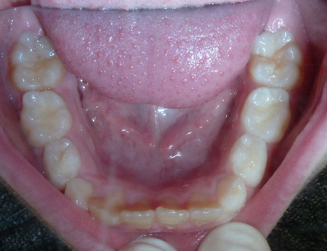 orthodontie-patient-04-apres