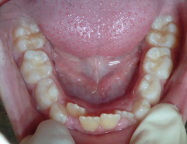 orthodontie-patient-04-avant
