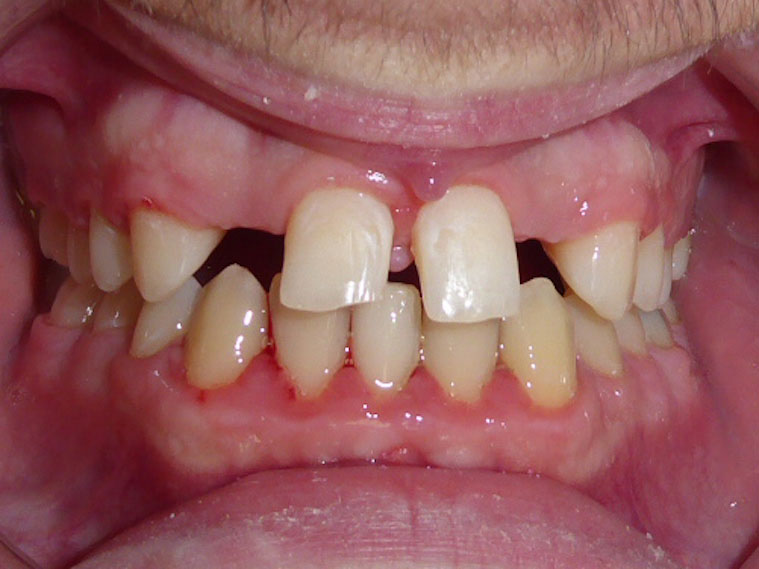 orthodontie-patient-05-avant